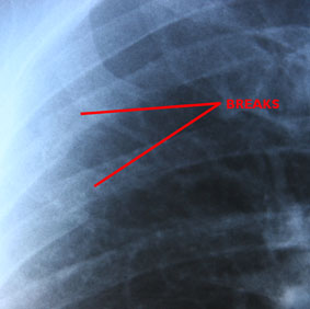 The First X-Ray